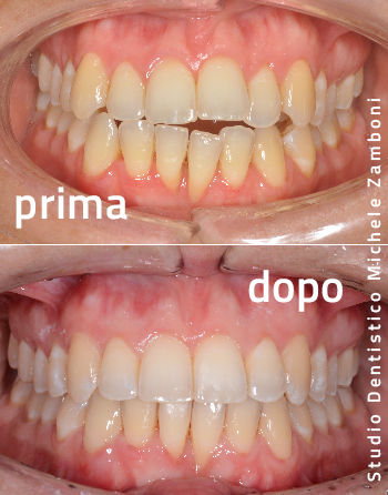 Ortodonzia dentale allineamento Arcate Dentali priama-dopo