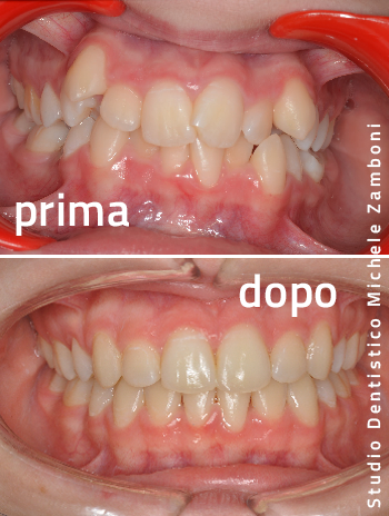 Ortodonzia dentale intercettiva allineamento Arcate Dentali pediatrico prima-dopo