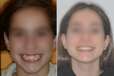 Ortodonzia Intercettiva - Correzione allineamento dentale 