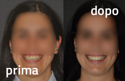 Ortodonzia dentale allineamento Arcate Dentali priama-dopo